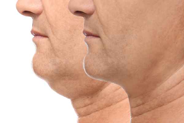 HIFU - Breakthrough in Anti - ageing 2 hifu results Doncaster