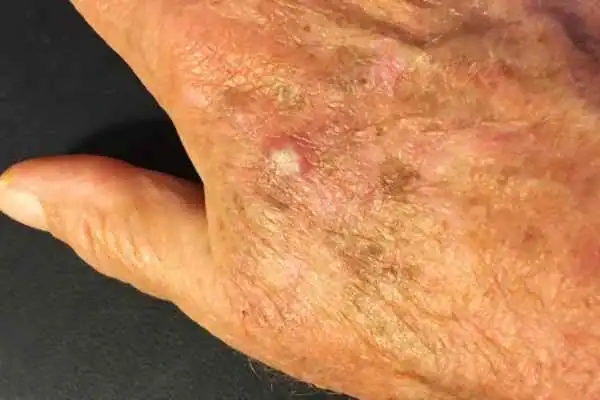 Image of Actinic keratoses Doncaster on a person hand