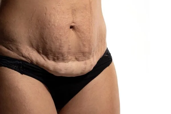 The Science of Skin Tightening 1 The science behind skin tightening Doncaster picture of a woman's sagging skin on the stomach